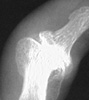 Osteoarththitis