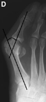 Severe Hallux Valgus