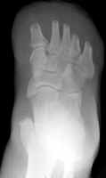 Transmetatarsal