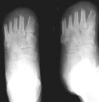 Transmetatarsal