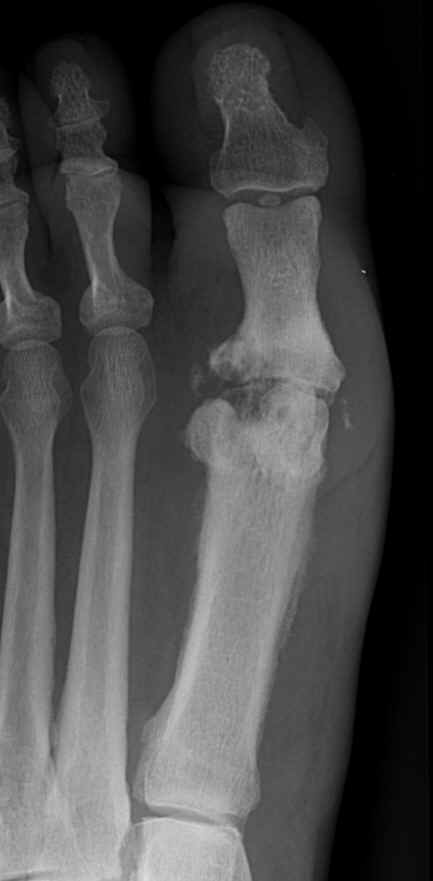 Osteomyelitis 1st Metatarsal Bone