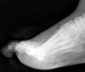 lateral foot with gas