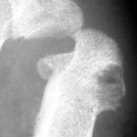 Ankylosing Spondylitis: erosions