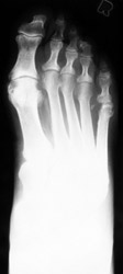 Ankylosing Spondylitis: Erosions of 5th MT head