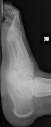 Charcot Joint: Lateral - Disorganization of Chopart joint