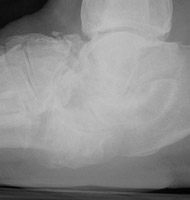 Charcot: Lateral  -  fracture,dislocation cChopart joint with sclerosis and debrit