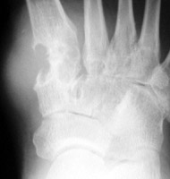 Gout: Erosions base 1st metatarsal with overhanging edges
