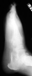 Tophaceus Gout: Lateral