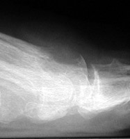 Gout: Erosions 1st MTP joint with preservation of joint space