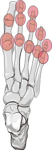 Psoriatic Arthritis - Distribution