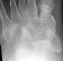 Rheumatoid Arthritis: Narrowing of Lisfranc and Chopart joint