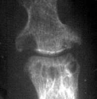 Rheumatoid Arthritis: Marginal erosions at 1st IP joint