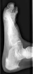 Reiter's Lateral: note changes of the calcaneus.