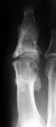 Silastic Hemiarthroplasty with large erosions 1st MT head, status post fusion 1st IP joint