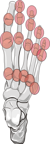 Gouty Arthritis Distribution