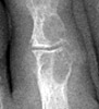 Gout: Erosion in both head of proximal phalanx and base middle phalanx 2nd toe with normal joint space