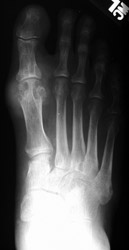 Gout: AP- Erosions 1st MTP joint with tophi