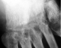 Gout: Erosions bases of metatardal bones