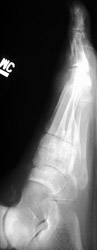 Gout: AP- Erosions 1st MTP joint with tophi