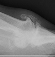 Osteoarthritis: Joint space narrowing and Osteophytes at 1st MTP joint