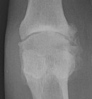 Osteoarthritis: Joint space narrowing and Osteophytes at 1st MTP joint
