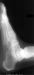 Psoriatic Arthritis: Lateral 