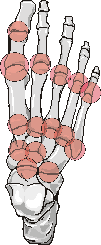 Rheumatoid Arthritis distribution