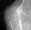 Rheumatoid Arthritis: Erosions  and subluxation 1st MTP joint