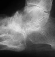 Rheumatoid Arthritis: Narrowing of Chopart joint
