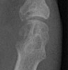 Rheumatoid Arthritis: Erosion 5th metatarsal head and base proximal phalanx