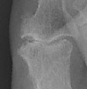 Reiter 's Erosion 1st IP joint with periostitis
