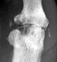 Septic Arthritis: Joint space narrowing and erosions