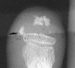 Scleroderma - Tuft reabsorption