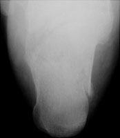 Inferior Calcaneal Spur