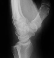 Hamate Fracture