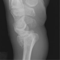 fracture colles