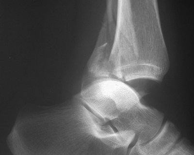 Distal fibula fractures are