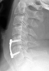 Latera C-spine - Click on the image to enlarge