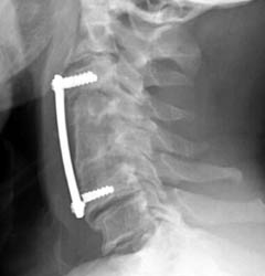 Latera C-spine - Click on the image to enlarge