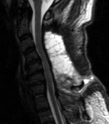 T2 Sagittal  - Click on the image to enlarge