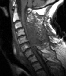 T1 Sagittal - Click on the image to enlarge