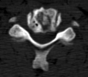 CT 8 months post op - Click on the image to enlarge