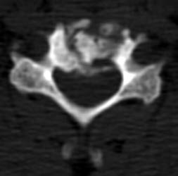 CT 8 months post op - Click on the image to enlarge