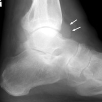 Lateral ankle - Click on the image for a larger version