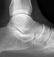Lateral normal ankle - Click on the image for a larger version