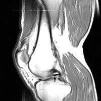 MRI Knee - Click on the image for a larger version