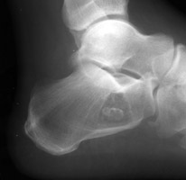 Lateral foot - Click on the image for a larger version