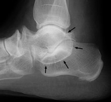 Lateral foot - Click on the image for a larger version