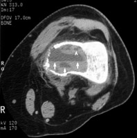 CT femur - Click on the image for a larger version