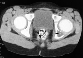 CT acetabulum - Click on the image for a larger version